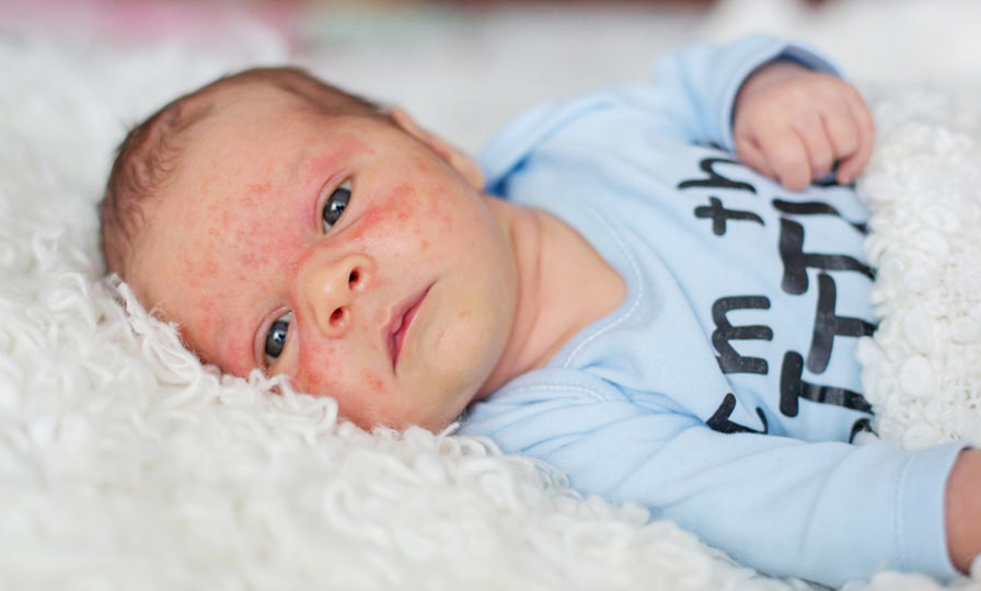 Профілактика та лікування прищів у малюка