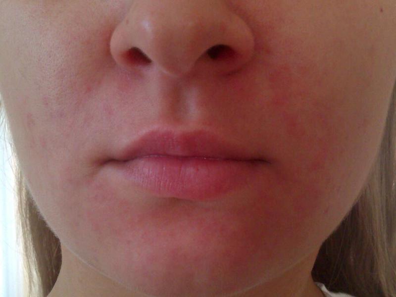 Види алергії на обличчі
