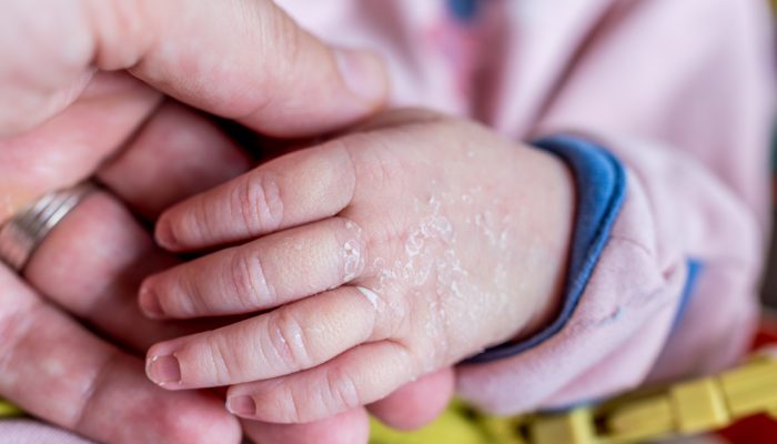Чому у новонародженого лущиться шкіра