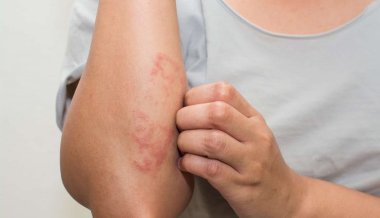 Причини лущення шкіри на ліктях способи позбавлення від недуги