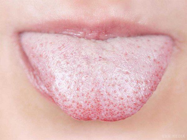 Причини виникнення білого нальоту на статевих губах