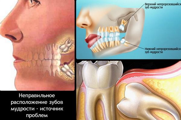 Видалення зуба мудрості та наслідки після хірургічного втручання
