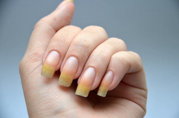 Причини і лікування жовтих нігтів на ногах і руках