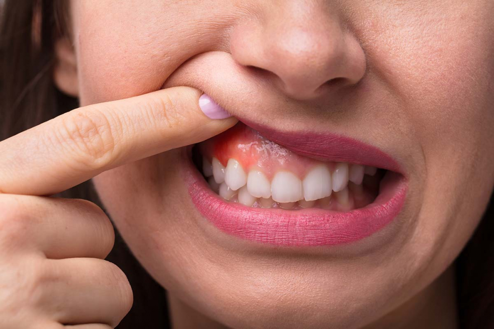 Як зміцнити ясна при захворюваннях порожнини рота