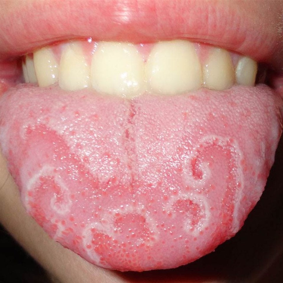 Лікування сухості у роті
