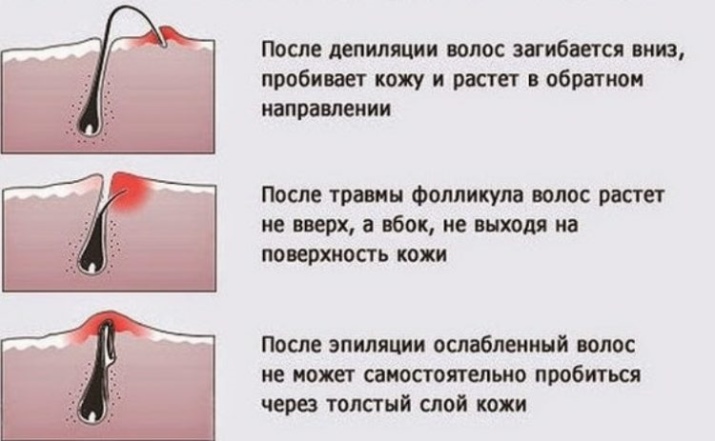 Як зняти роздратування на ногах після епіляції