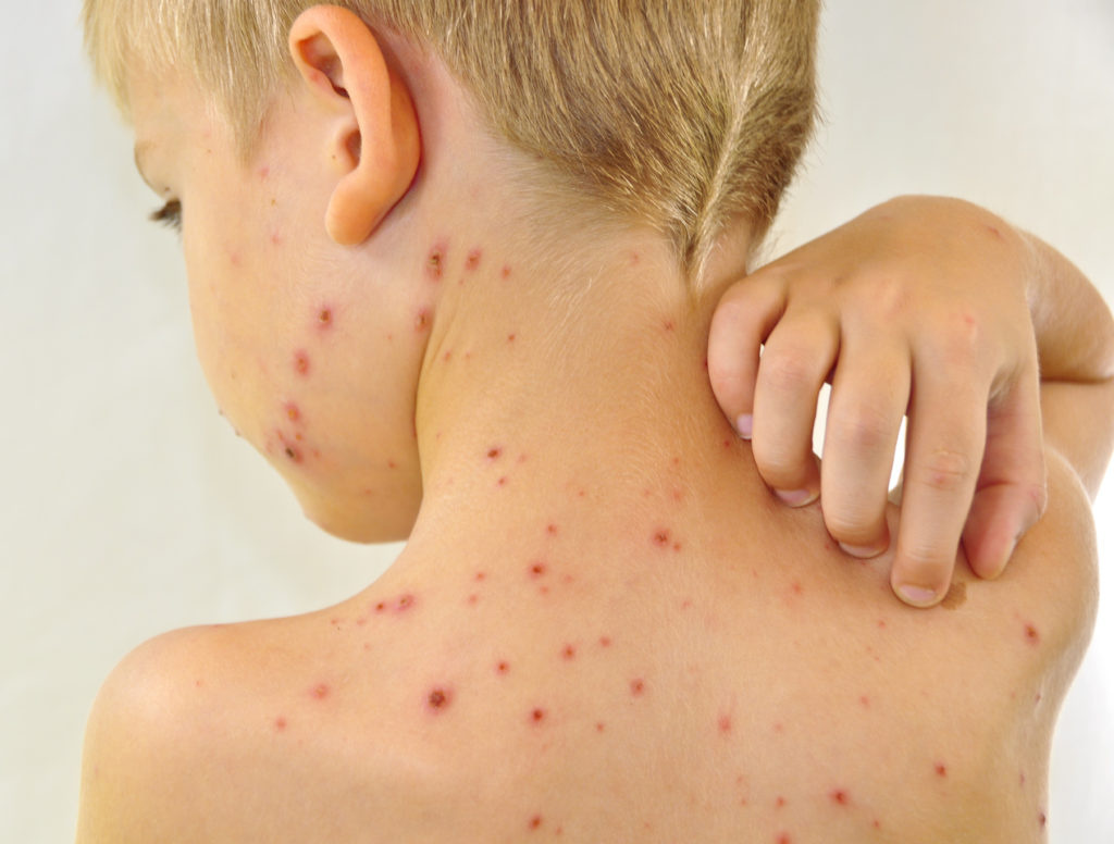 Причини виникнення алергічного висипу на шкірі обличчя