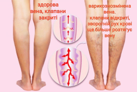 Варикоз вен на ногах лікування народними засобами