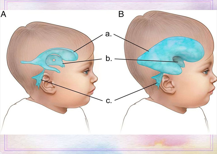 Наслідки гідроцефалії виявленої у новонароджених