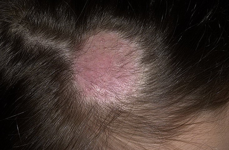 Грибкові ураження шкіри голови: симптоми і різновиди