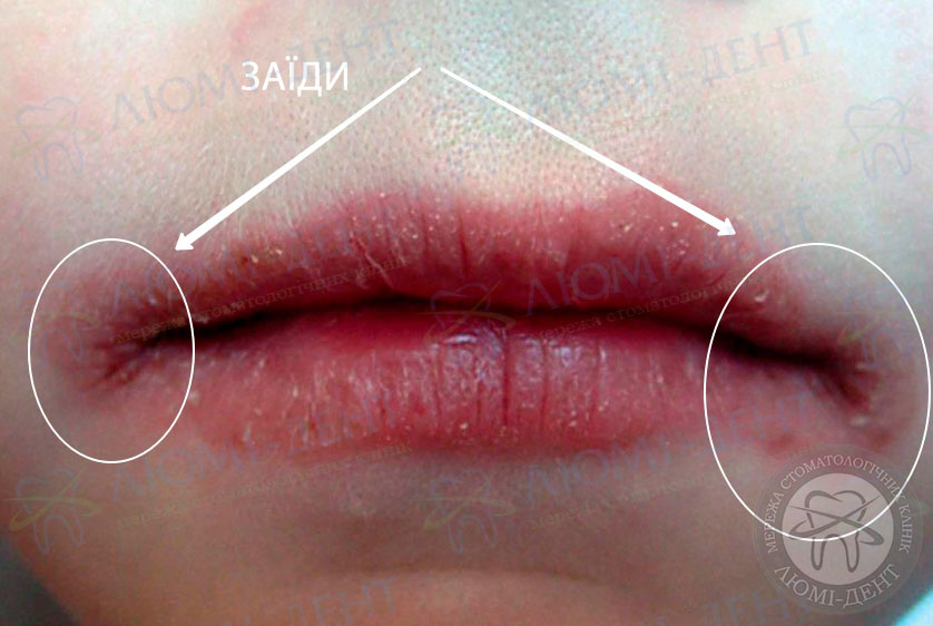 Чим потрібно лікувати тріщини в куточках губ