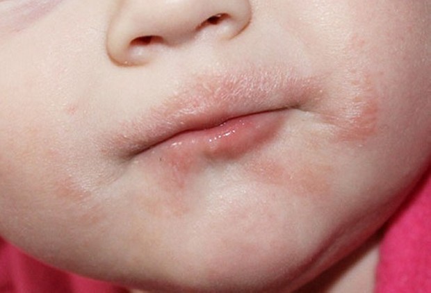 Лікування алергії у дітей грудного та дошкільного віку