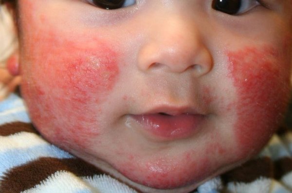 Народна медицина проти алергії на обличчі