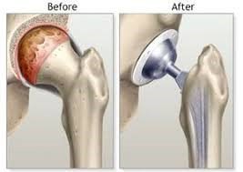 Як можна лікувати остеоатроз колінного суглоба