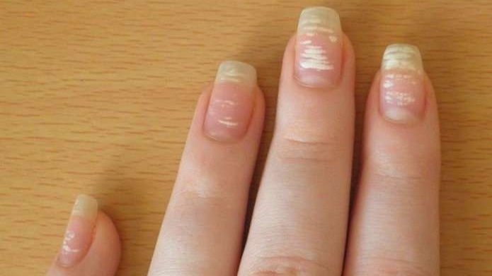 Які можуть бути причини білих плям на нігтях