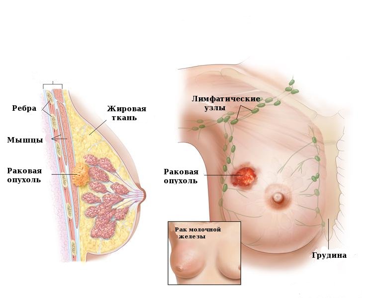 Причини ущільнення в області грудної клітки
