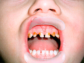 Карієс молочних зубів у дітей та його лікування