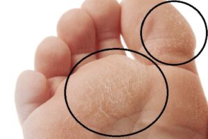 Натоптиші на пальцях ніг – як позбавитися