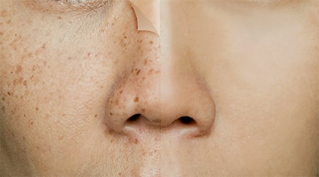 Білі плями на обличчі причини появи пігментних проявів на шкірі
