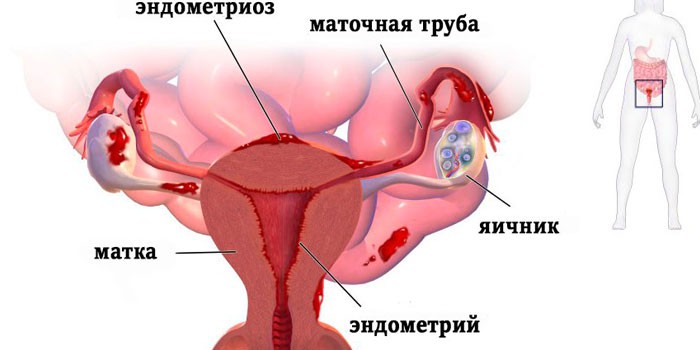 Ендометріоз і вагітність