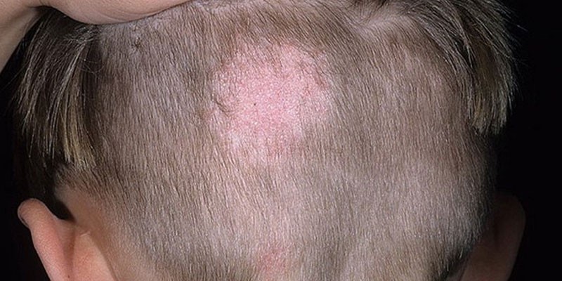 Грибок шкіри голови симптоми лікування профілактика