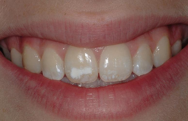 Як відновити емаль зубів і повернути собі гарну посмішку