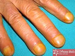 Жовті плями на нігтях причини і способи позбавлення