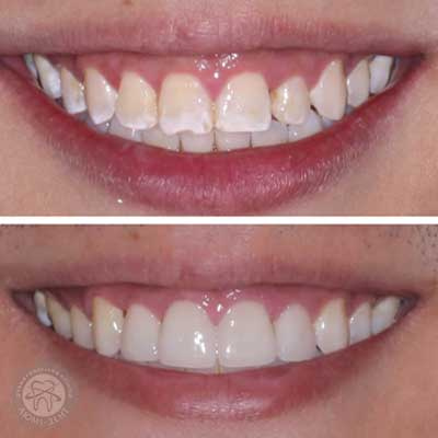 Удосконалення свого харчування, правильна і регулярна гігієна порожнини рота та відвідування стоматолога є основними кроками до зміцнення та відновлення зубної емалі. Пам