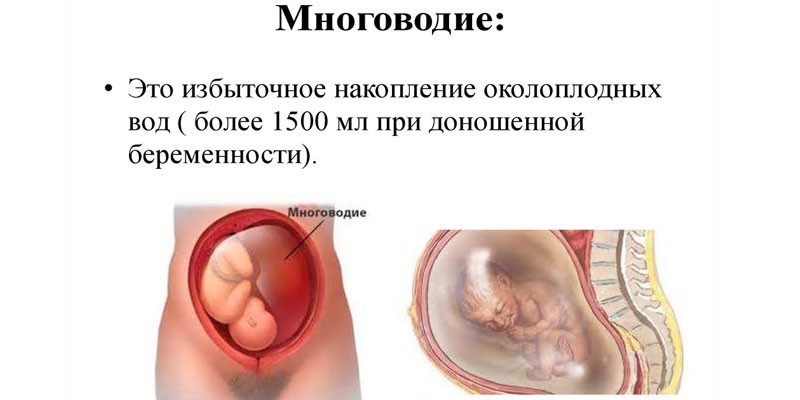 Помірне багатоводдя при вагітності
