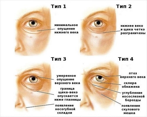 Застосування масок від зморшок навколо очей в домашніх умовах