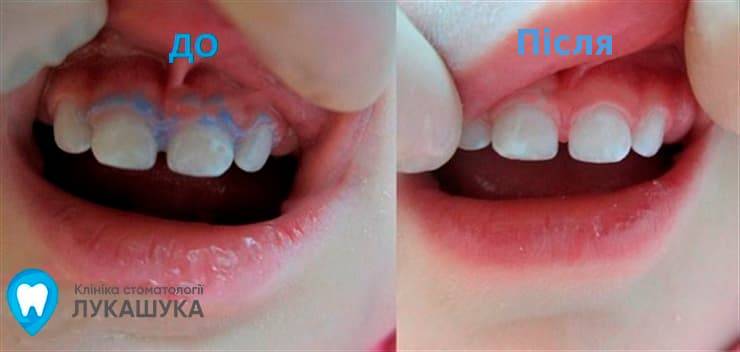 Сріблення проти карієсу молочних зубів