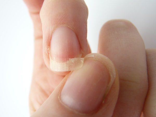Чому шаруються нігті з’ясовуємо причини