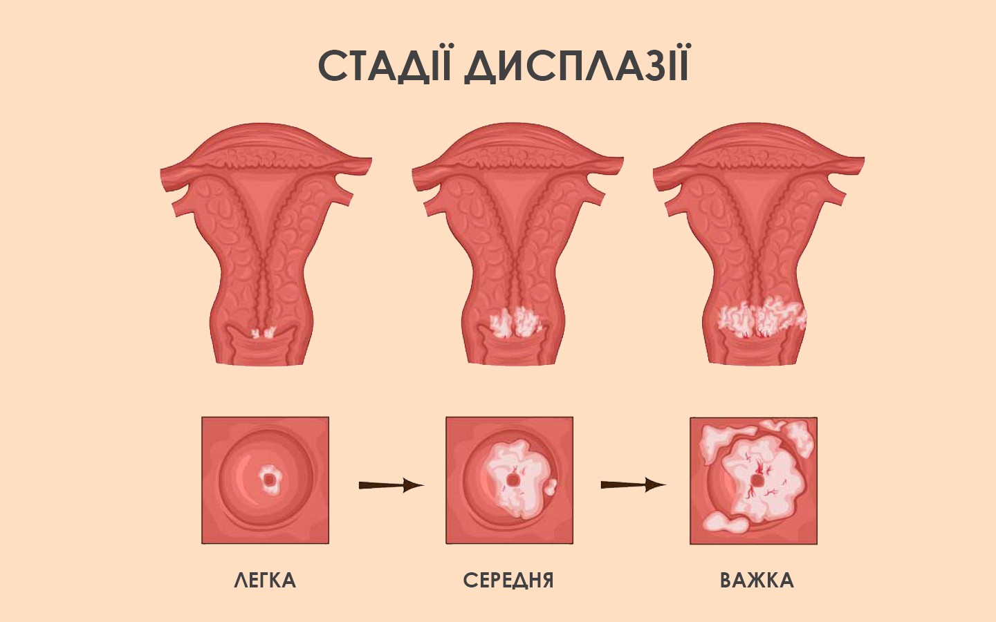 Дисплазія шийки матки та її види 