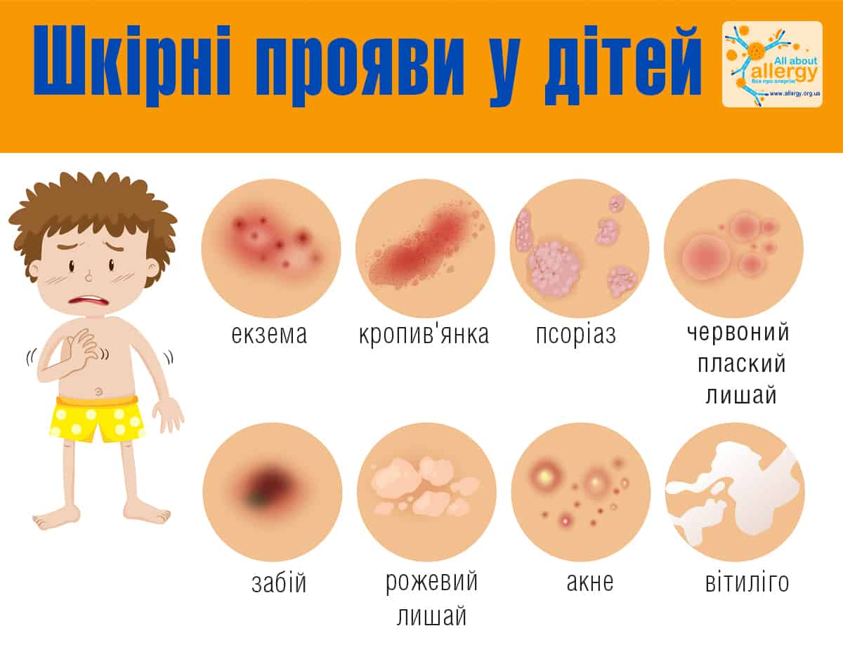 Класифікація алергічних реакцій