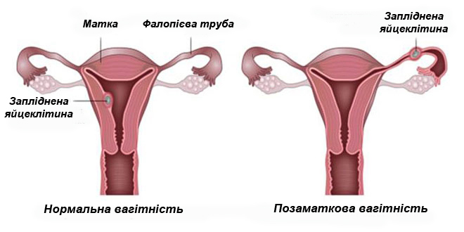 Ознаки позаматкової вагітності