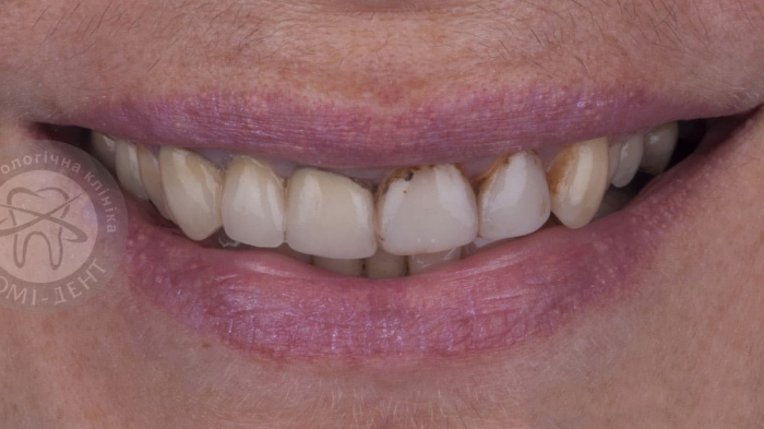 Процес відновлення зубної емалі позначається незворотніми змінами у структурі зуба. Коли емаль пошкоджується, наростає ризик розвитку карієсу та зубного відкладення. Щоб уникнути цих проблем, необхідно усвідомлено підходити до своєї усної гігієни та слідкувати за станом зубної емалі.