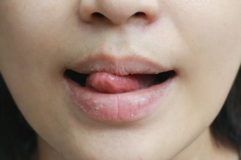Тріщини в куточках губ чому з’являються і як лікувати