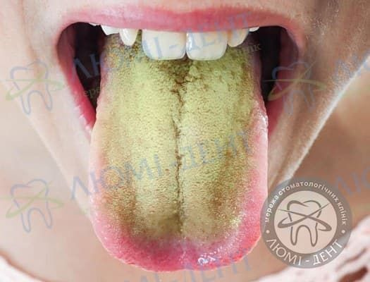 Чому виникає жовтий наліт на язиці